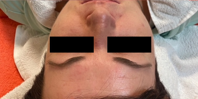 odstranenie cievok rosacea osetrenie 1