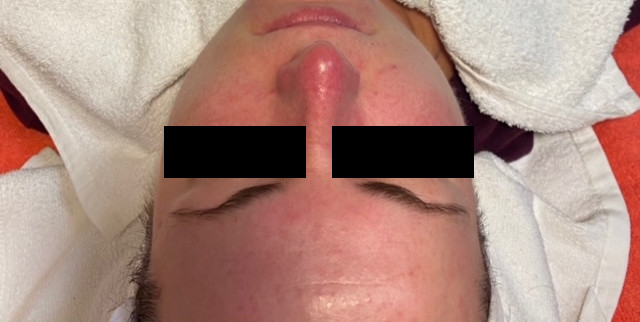 odstranenie cievok rosacea osetrenie 2