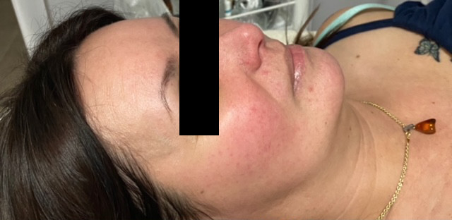 odstranenie cievok rosacea osetrenie 4