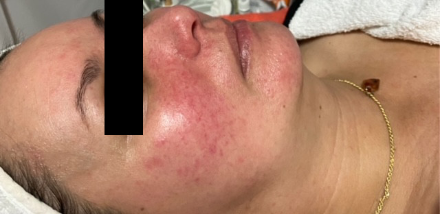 odstranenie cievok rosacea osetrenie 3